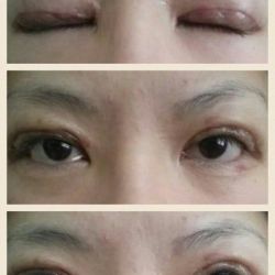 Mí mắt không đều, đây có phải là cắt mí hỏng không?