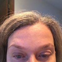 Nổi cục nhọn sau khi căng da bằng chỉ Silhouette Nổi cục nhọn sau khi căng da bằng chỉ Silhouette