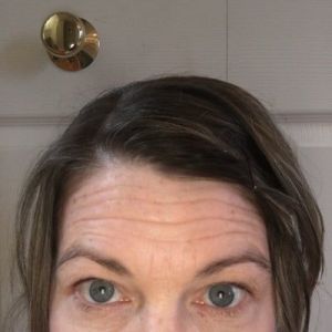 Phương pháp cắt mí có thể loại bỏ nếp nhăn trán không?