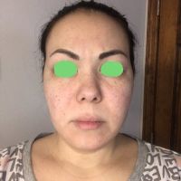 Căng da bằng chỉ Silhouette có thể làm đường viền hàm sắc nét hơn không? Căng da bằng chỉ Silhouette có thể làm đường viền hàm sắc nét hơn không?