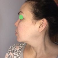 Căng da bằng chỉ Silhouette có thể làm đường viền hàm sắc nét hơn không? Căng da bằng chỉ Silhouette có thể làm đường viền hàm sắc nét hơn không?