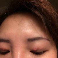 Nổi cục màu đỏ trên đường rạch cắt mí