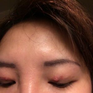 Nổi cục màu đỏ trên đường rạch cắt mí