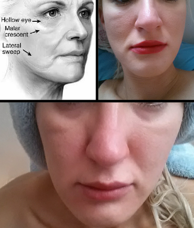 Hành trình cấy mỡ tự thân giúp cô gái thay đổi khuôn mặt gầy không cân đối vì nằm nghiêng một bên quá nhiều