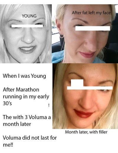 Hành trình cấy mỡ tự thân giúp cô gái thay đổi khuôn mặt gầy không cân đối vì nằm nghiêng một bên quá nhiều