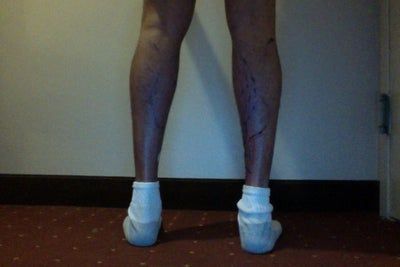 Hành trình lấy lại vẻ nam tính và tự tin của quý ông sau cấy mỡ tự thân vào chân, loại bỏ bắp chân gầy tong teo