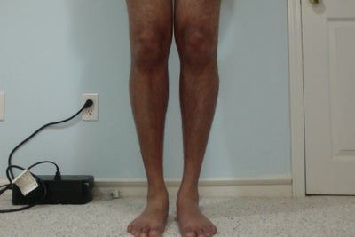 Hành trình lấy lại vẻ nam tính và tự tin của quý ông sau cấy mỡ tự thân vào chân, loại bỏ bắp chân gầy tong teo