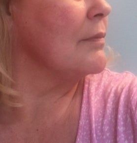 Kết quả bất ngờ từ liệu trình Ultherapy nâng cơ trẻ hóa vùng mặt dưới cho người phụ nữ 53 tuổi