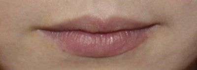 Hành trình cấy mỡ tự thân vào môi, “biến hóa” đôi môi mỏng trở nên căng mọng đầy sức sống