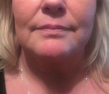 Kết quả bất ngờ từ liệu trình Ultherapy nâng cơ trẻ hóa vùng mặt dưới cho người phụ nữ 53 tuổi