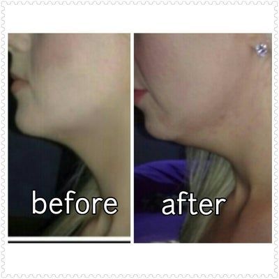 Lần đầu trong đời có được chiếc cằm thực sự với đường viền quai hàm thon gọn sau liệu trình tiêm Kybella