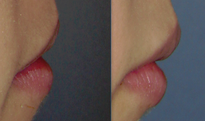 Hành trình cấy mỡ tự thân vào môi, “biến hóa” đôi môi mỏng trở nên căng mọng đầy sức sống