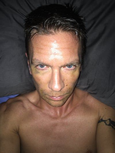 Hành trình 2 lần cấy mỡ tự thân để vĩnh biệt khuôn mặt hóp già nua, tự tin sở hữu gương mặt đường nét, nam tính