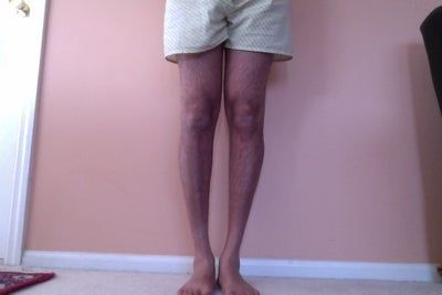 Hành trình lấy lại vẻ nam tính và tự tin của quý ông sau cấy mỡ tự thân vào chân, loại bỏ bắp chân gầy tong teo