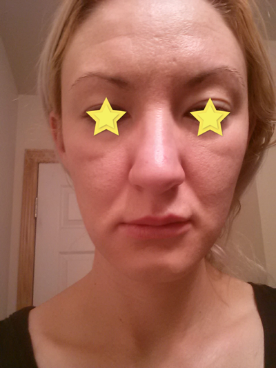 Hành trình cấy mỡ tự thân giúp cô gái thay đổi khuôn mặt gầy không cân đối vì nằm nghiêng một bên quá nhiều