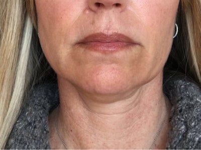 Quá trình tiêm Kybella điêu khắc vùng hàm và loại bỏ túi mỡ thừa lỏng lẻo dưới cằm