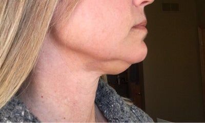 Quá trình tiêm Kybella điêu khắc vùng hàm và loại bỏ túi mỡ thừa lỏng lẻo dưới cằm