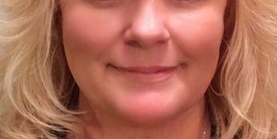 Kết quả bất ngờ từ liệu trình Ultherapy nâng cơ trẻ hóa vùng mặt dưới cho người phụ nữ 53 tuổi