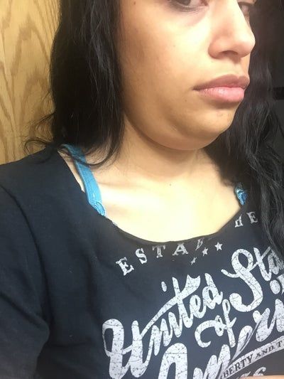Đường viền quai hàm và khuôn mặt cô gái thay đổi rõ rệt sau khi tiêm 2 lọ Kybella