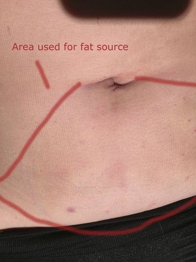 Hành trình cấy mỡ tự thân vào môi, “biến hóa” đôi môi mỏng trở nên căng mọng đầy sức sống