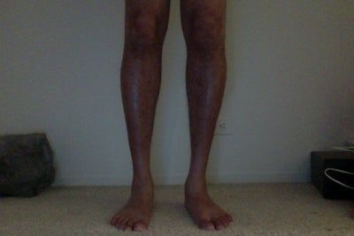 Hành trình lấy lại vẻ nam tính và tự tin của quý ông sau cấy mỡ tự thân vào chân, loại bỏ bắp chân gầy tong teo