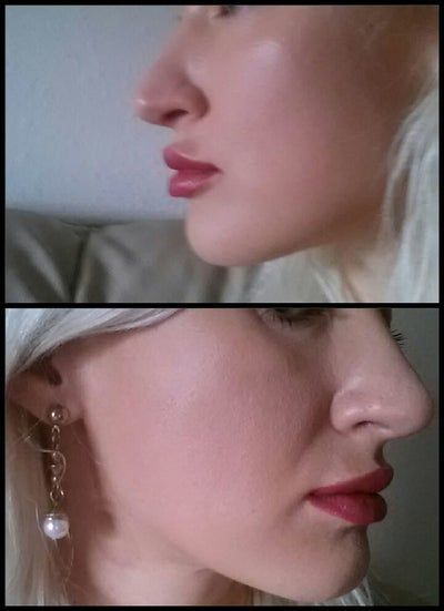 Hành trình cấy mỡ tự thân giúp cô gái thay đổi khuôn mặt gầy không cân đối vì nằm nghiêng một bên quá nhiều