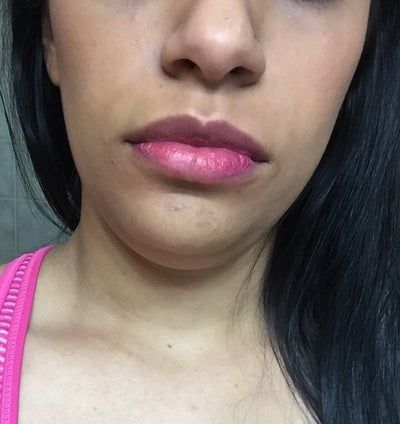 Quá trình tiêm Kybella điêu khắc vùng hàm và loại bỏ túi mỡ thừa lỏng lẻo dưới cằm