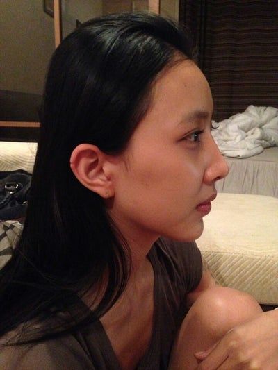 Quá trình cấy mỡ tự thân tạm biệt vẻ già nua của cô người mẫu 27 tuổi