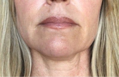 Quá trình tiêm Kybella điêu khắc vùng hàm và loại bỏ túi mỡ thừa lỏng lẻo dưới cằm
