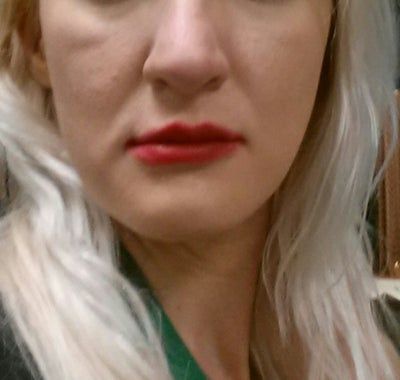 Hành trình cấy mỡ tự thân giúp cô gái thay đổi khuôn mặt gầy không cân đối vì nằm nghiêng một bên quá nhiều