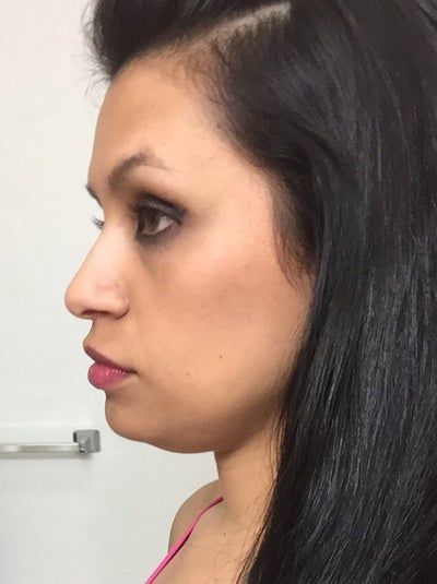 Đường viền quai hàm và khuôn mặt cô gái thay đổi rõ rệt sau khi tiêm 2 lọ Kybella