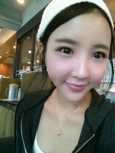 Quá trình cấy mỡ tự thân tạm biệt vẻ già nua của cô người mẫu 27 tuổi