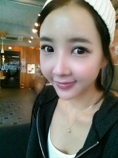 Quá trình cấy mỡ tự thân tạm biệt vẻ già nua của cô người mẫu 27 tuổi