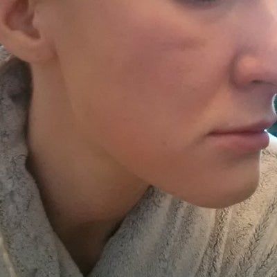 Hành trình cấy mỡ tự thân giúp cô gái thay đổi khuôn mặt gầy không cân đối vì nằm nghiêng một bên quá nhiều