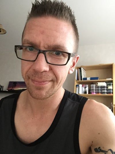 Hành trình 2 lần cấy mỡ tự thân để vĩnh biệt khuôn mặt hóp già nua, tự tin sở hữu gương mặt đường nét, nam tính