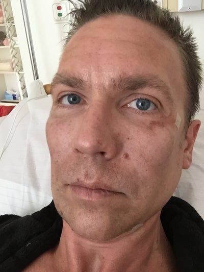 Hành trình 2 lần cấy mỡ tự thân để vĩnh biệt khuôn mặt hóp già nua, tự tin sở hữu gương mặt đường nét, nam tính