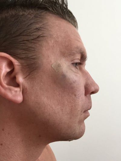 Hành trình 2 lần cấy mỡ tự thân để vĩnh biệt khuôn mặt hóp già nua, tự tin sở hữu gương mặt đường nét, nam tính