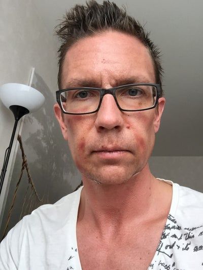 Hành trình 2 lần cấy mỡ tự thân để vĩnh biệt khuôn mặt hóp già nua, tự tin sở hữu gương mặt đường nét, nam tính