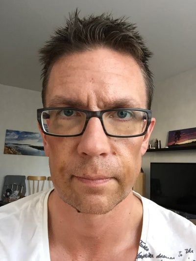 Hành trình 2 lần cấy mỡ tự thân để vĩnh biệt khuôn mặt hóp già nua, tự tin sở hữu gương mặt đường nét, nam tính