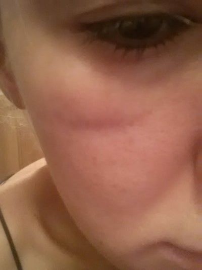 Hành trình cấy mỡ tự thân giúp cô gái thay đổi khuôn mặt gầy không cân đối vì nằm nghiêng một bên quá nhiều