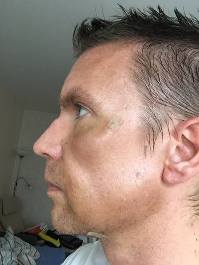 Hành trình 2 lần cấy mỡ tự thân để vĩnh biệt khuôn mặt hóp già nua, tự tin sở hữu gương mặt đường nét, nam tính