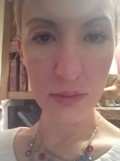 Hành trình cấy mỡ tự thân giúp cô gái thay đổi khuôn mặt gầy không cân đối vì nằm nghiêng một bên quá nhiều