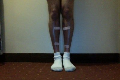 Hành trình lấy lại vẻ nam tính và tự tin của quý ông sau cấy mỡ tự thân vào chân, loại bỏ bắp chân gầy tong teo