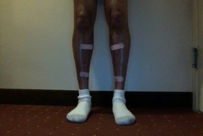 Hành trình lấy lại vẻ nam tính và tự tin của quý ông sau cấy mỡ tự thân vào chân, loại bỏ bắp chân gầy tong teo