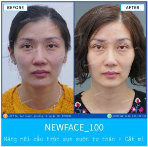 Hình ảnh nâng mũi trước sau Bs Trần Phương - Ca 100