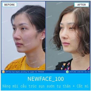 Hình ảnh nâng mũi trước sau Bs Trần Phương - Ca 100