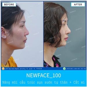 Hình ảnh nâng mũi trước sau Bs Trần Phương - Ca 100