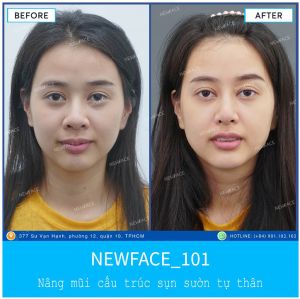 Hình ảnh nâng mũi trước sau Bs Trần Phương - Ca 101