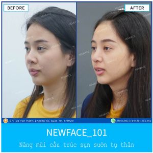 Hình ảnh nâng mũi trước sau Bs Trần Phương - Ca 101