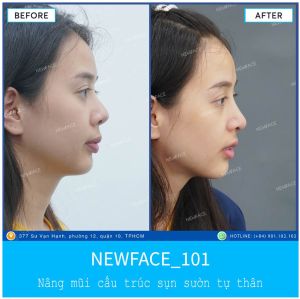 Hình ảnh nâng mũi trước sau Bs Trần Phương - Ca 101